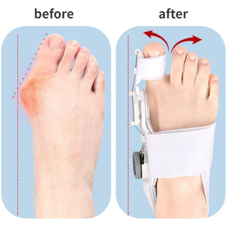 HalluxAlign™ Upgraded Bunion Corrector